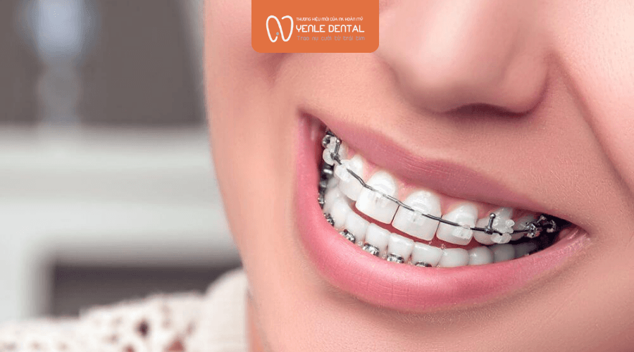 niềng răng xong bị mặt lệch